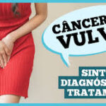 Já ouviu falar de câncer de vulva? Caroço, coceira e feridas podem ser sintomas Já ouviu falar de câncer de vulva? Caroço, coceira e feridas podem ser sintomas