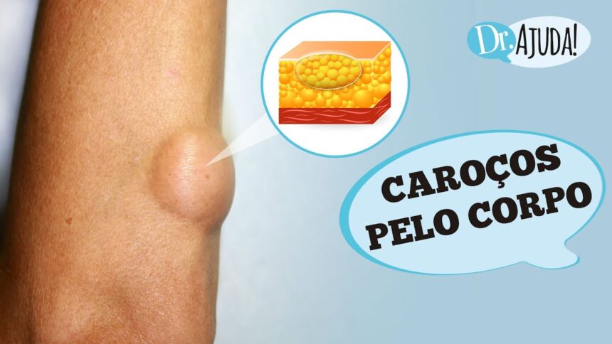 Caroços pelo corpo e lipoma: O que são? O que reparar? Caroços pelo corpo e lipoma: O que são? O que reparar?