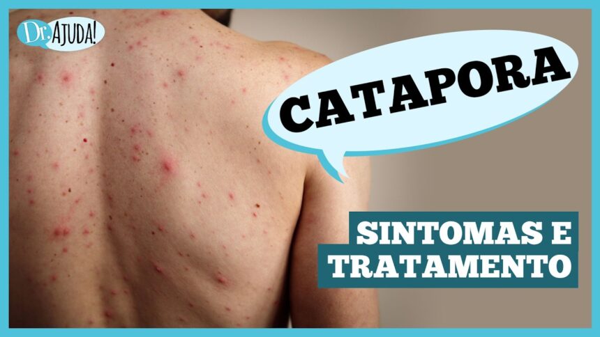 Catapora: sintomas, complicações e prevenção Catapora: sintomas, complicações e prevenção