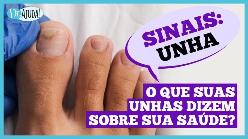 Dr. Ajuda: Unhas fracas podem indicar problemas de saúde Dr. Ajuda: Unhas fracas podem indicar problemas de saúde