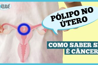 O que são pólipos uterino e quais os sintomas?