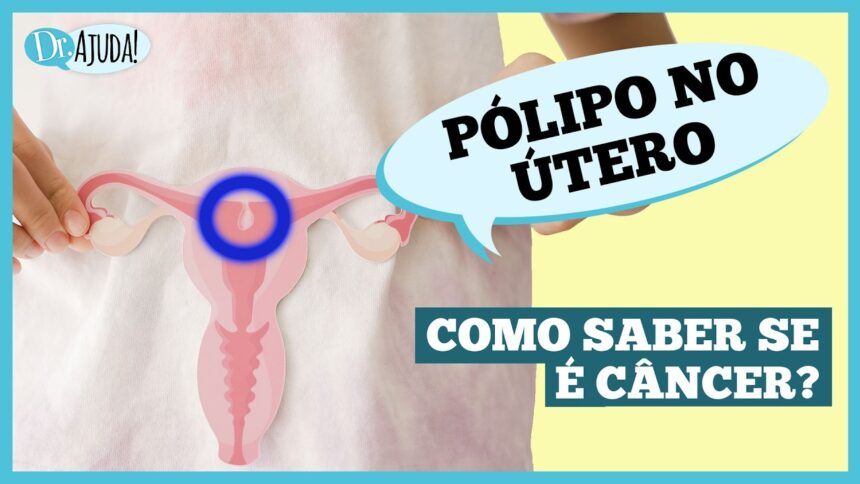 O que são pólipos uterino e quais os sintomas?