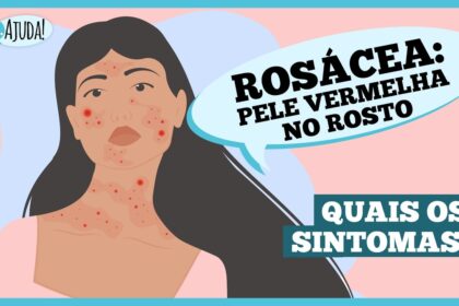 Rosácea: o que é e quais são os sintomas