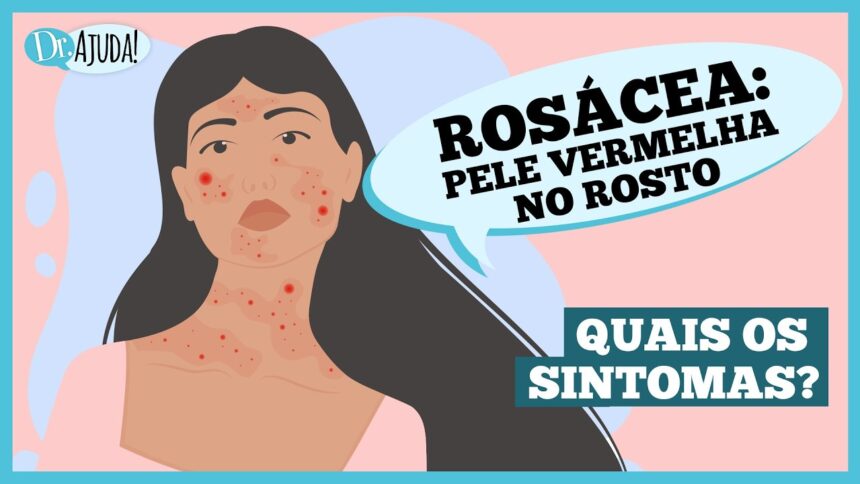 Rosácea: o que é e quais são os sintomas