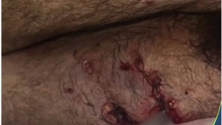 Ataque de pitbull deixa homem ferido no oeste de Goianésia