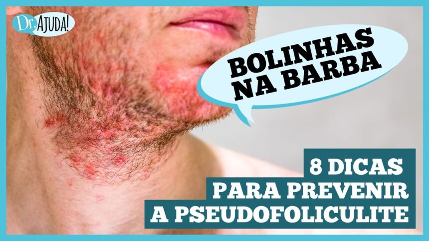 Pseudofoliculite: saiba como prevenir