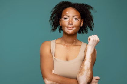 Entenda as causas e os tratamentos para o vitiligo Entenda as causas e os tratamentos para o vitiligo