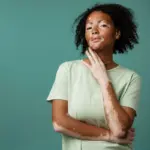 Conheça os principais sinais do vitiligo