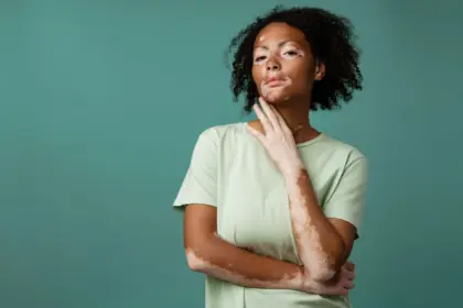 Conheça os principais sinais do vitiligo Conheça os principais sinais do vitiligo