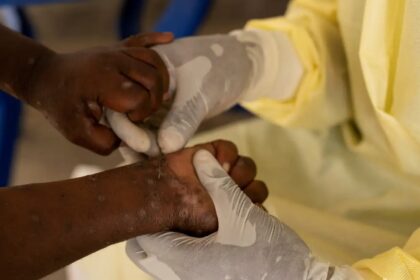 Brasil registra 88 casos de Mpox em 2026; saiba como evitar a doença