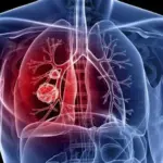 Ceap-Sol alerta para importância do diagnóstico precoce no combate à tuberculose