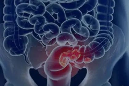 Rastreamento para câncer colorretal pode ser implementado no SUS