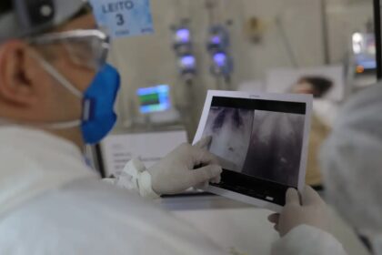 Broncopneumonia: entenda quadro que causou internação de Bolsonaro