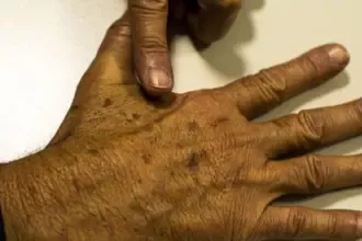 Desinformação sobre câncer de pele afeta diagnóstico, diz instituição