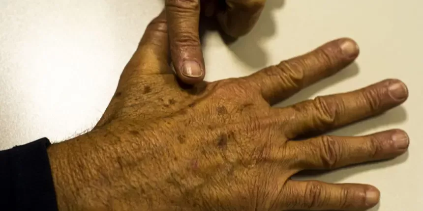 Desinformação sobre câncer de pele afeta diagnóstico, diz instituição Desinformação sobre câncer de pele afeta diagnóstico, diz instituição