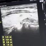 A pedido do vereador Marcos Pernambuco, mutirão em Goianésia faz 300 atendimentos contra câncer de tireoide