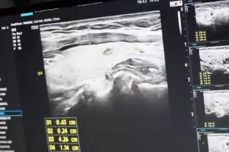 A pedido do vereador Marcos Pernambuco, mutirão em Goianésia faz 300 atendimentos contra câncer de tireoide