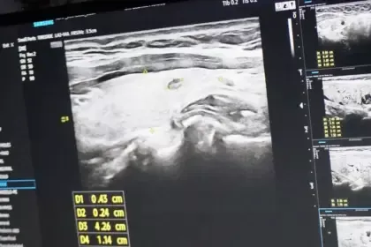 A pedido do vereador Marcos Pernambuco, mutirão em Goianésia faz 300 atendimentos contra câncer de tireoide