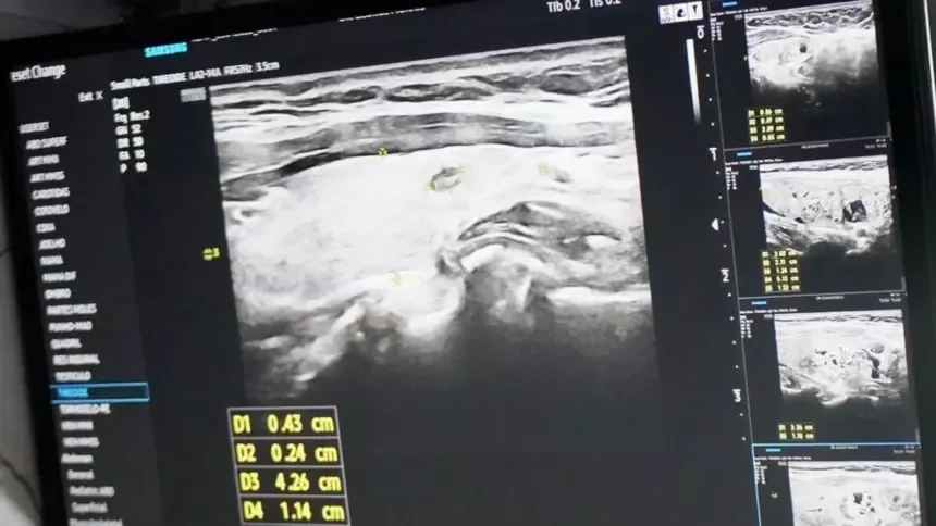 A pedido do vereador Marcos Pernambuco, mutirão em Goianésia faz 300 atendimentos contra câncer de tireoide